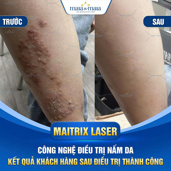 feedback nấm da chân