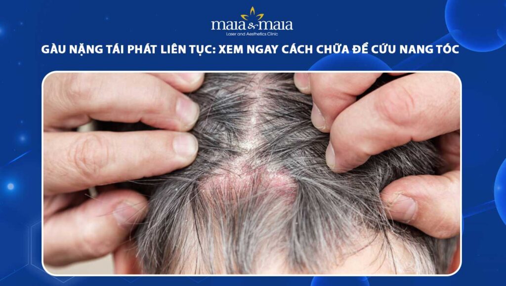 gàu nặng