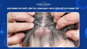 gàu nặng