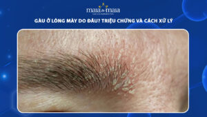 gàu ở lông mày