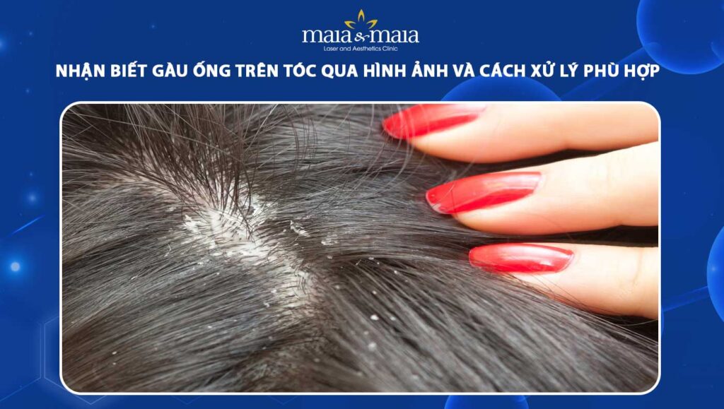 gàu ống