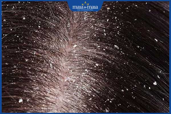 gàu ướt mất thẩm mỹ