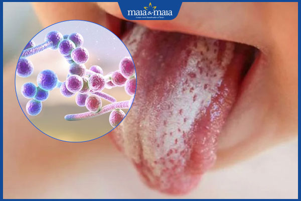 nấm candida