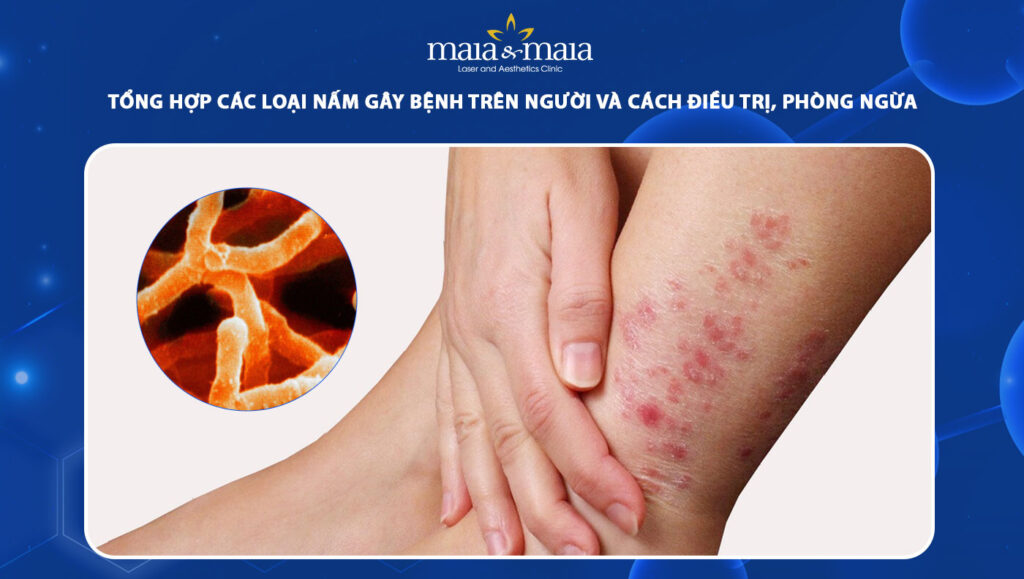 nấm gây bệnh trên người