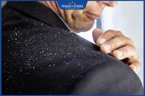 Gàu là gì? Làm sao để cải thiện da đầu sạch khỏe hơn? 4 nam giới bị gàu