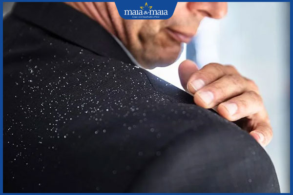 Bật mí cách trị gàu cho nam hiệu quả, an toàn cho da đầu 2 nam giới bị gàu