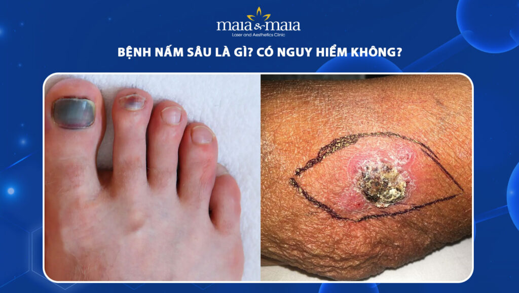 nấm sâu