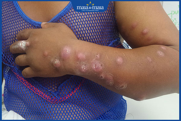 nấm sporotrichosis