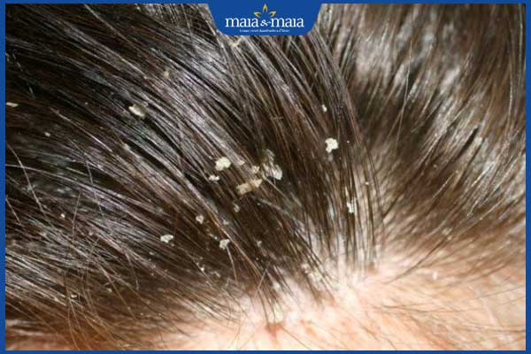 Gàu là gì? Làm sao để cải thiện da đầu sạch khỏe hơn? 2 nhận biết gàu