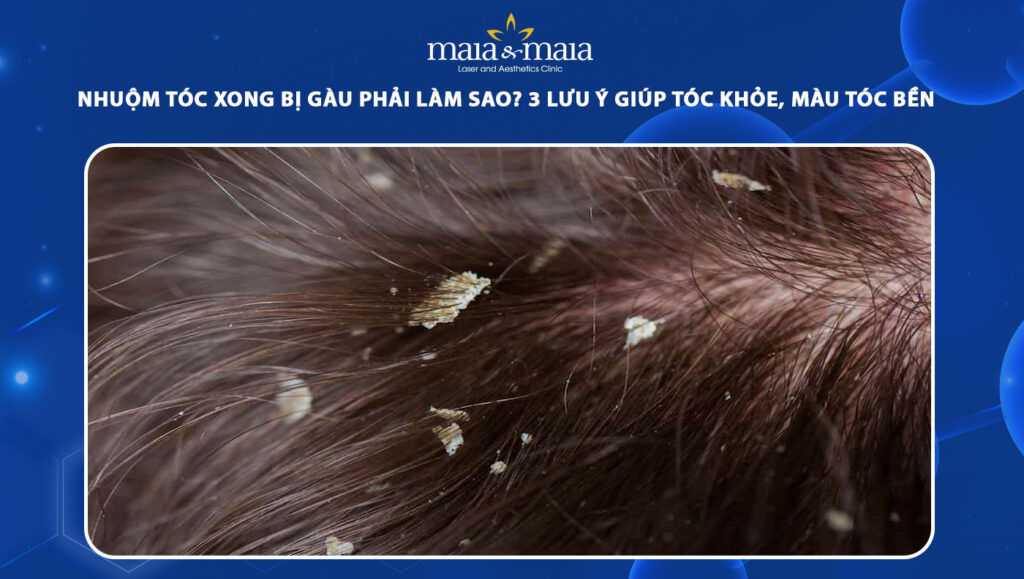 nhuộm tóc xong bị gàu