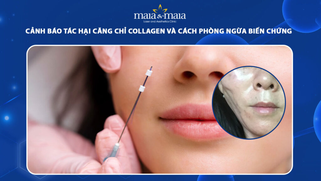 tác hại căng chỉ collagen