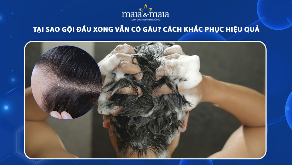 tại sao gội đầu xong vẫn có gàu