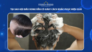 tại sao gội đầu xong vẫn có gàu