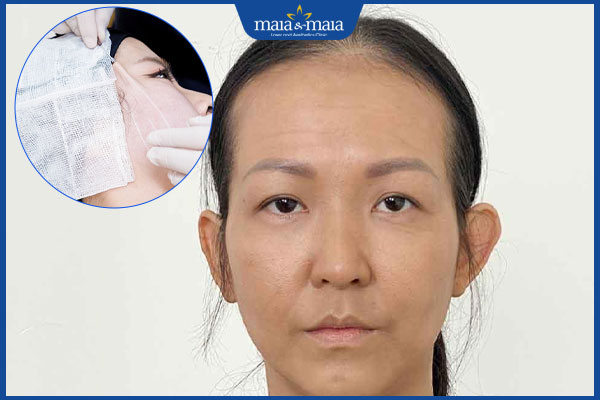 Căng chỉ làm đầy thái dương là gì? Hiệu quả có tốt không? 4 thái dương lõm
