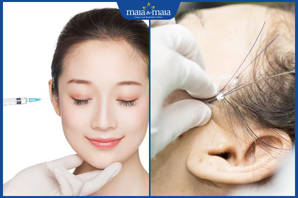 Căng chỉ làm đầy thái dương là gì? Hiệu quả có tốt không? 3 tiêm filler và căng chỉ