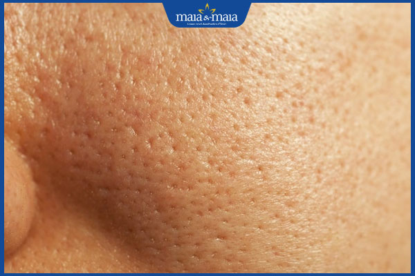 Top 10 sữa rửa mặt se khít lỗ chân lông hiệu quả và an toàn 2 tình trạng lỗ chân lông to