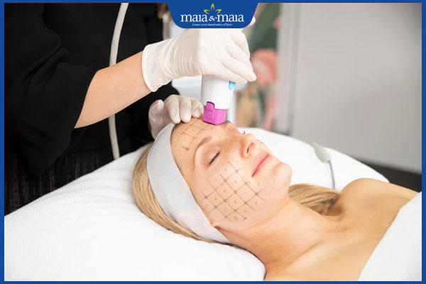 Thermage FLX giữ được bao lâu? Yếu tố quyết định hiệu quả 2 trẻ hóa bằng máy thermage