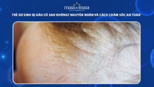 trẻ sơ sinh bị gàu