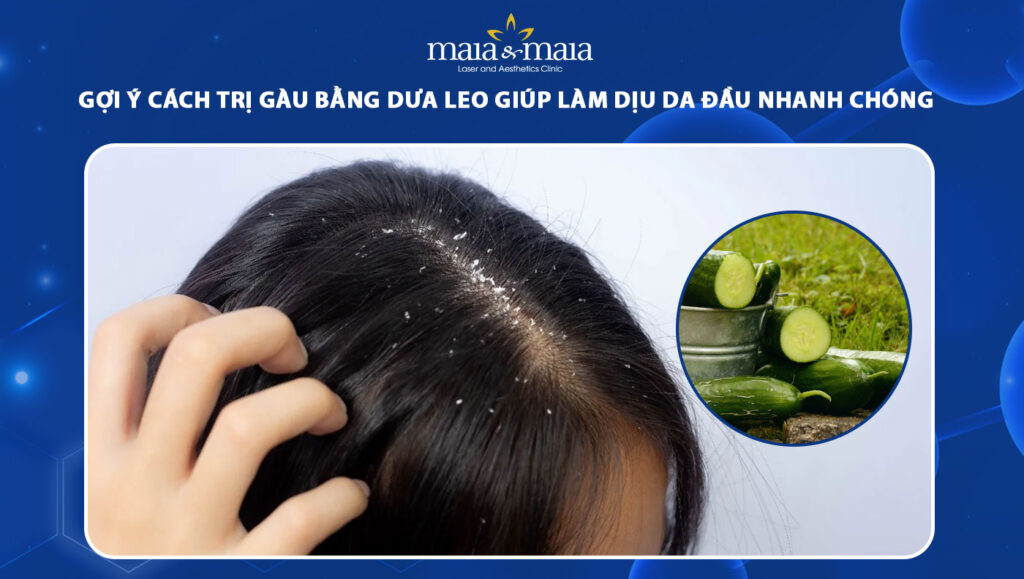 Cách trị gàu bằng dưa leo giúp dịu da đầu ngứa, bong tróc 1 trị gàu bằng dưa leo