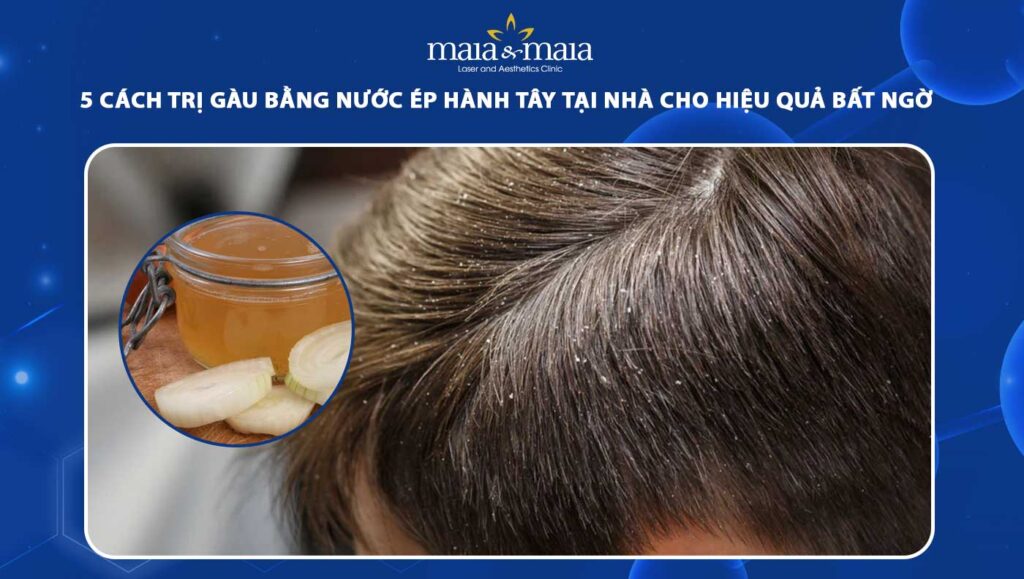 trị gàu bằng nước ép hành tây