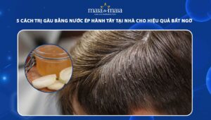 trị gàu bằng nước ép hành tây