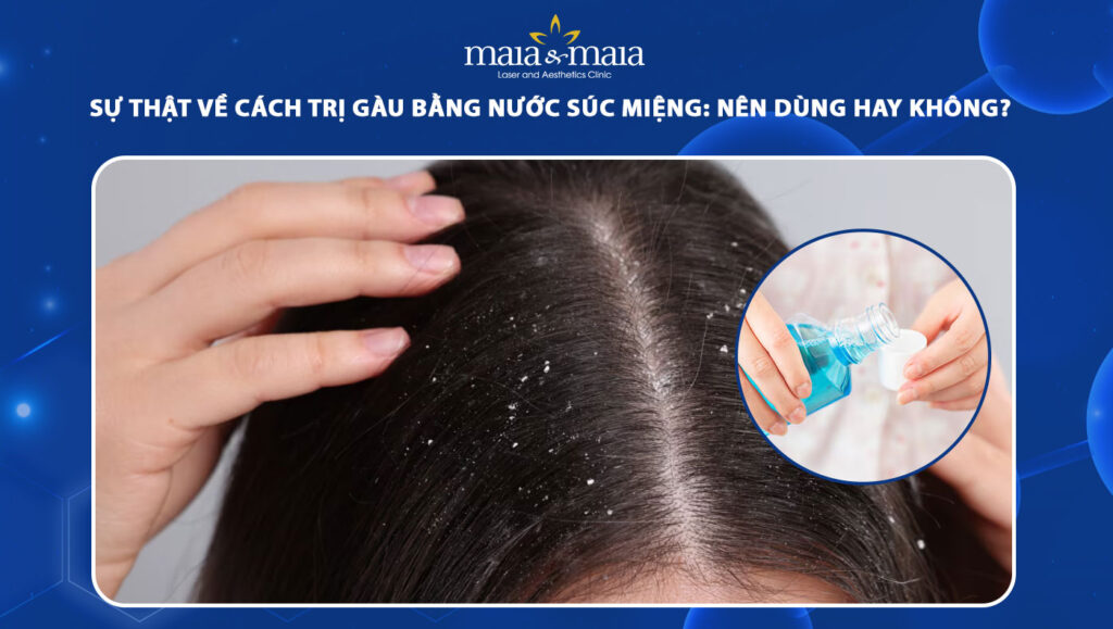 trị gàu bằng nước súc miệng