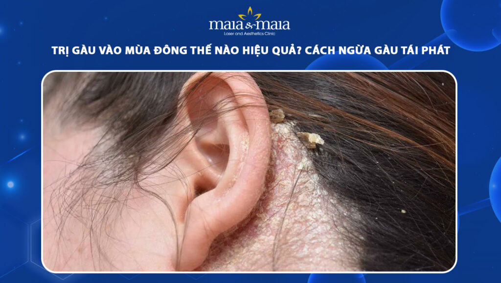 trị gàu vào mùa đông