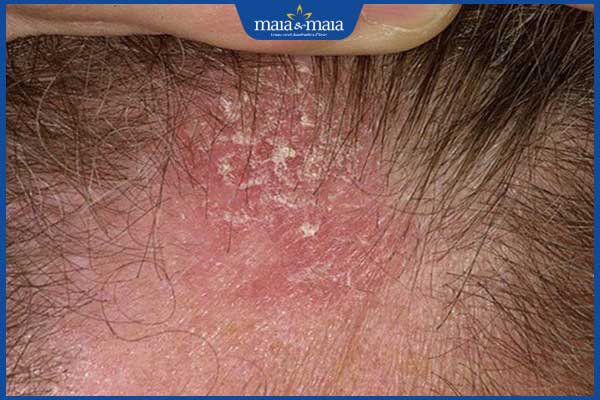 Gàu là gì? Làm sao để cải thiện da đầu sạch khỏe hơn? 3 viêm da đầu