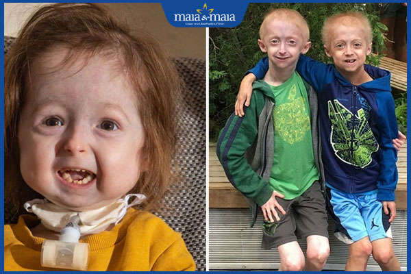Hội chứng Progeria là gì? Nguyên nhân và cách điều trị 4 biến chứng trẻ Progeria