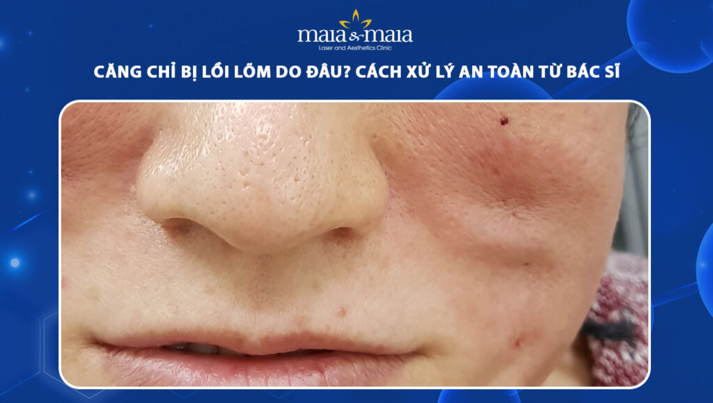 căng chỉ bị lồi lõm