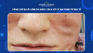 căng chỉ bị lồi lõm