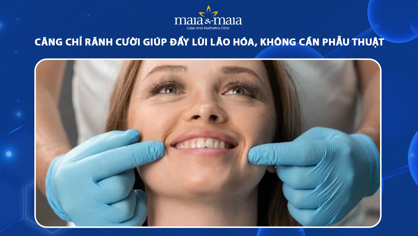 căng chỉ rãnh cười