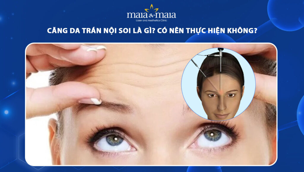 Căng da trán nội soi có hiệu quả không? Giá bao nhiêu? 1 căng da trán nội soi