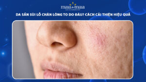 da sần sùi lỗ chân lông to