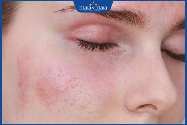 da sưng đỏ sau laser