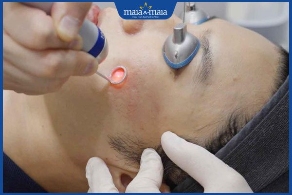 Quy trình se khít lỗ chân lông bằng laser & chi phí thực hiện 2 dùng laser trẻ hoa