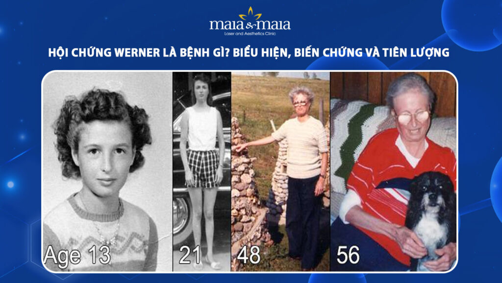 Hội chứng Werner: Biểu hiện, biến chứng và tiên lượng 1 hội chứng werner