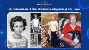 hội chứng werner