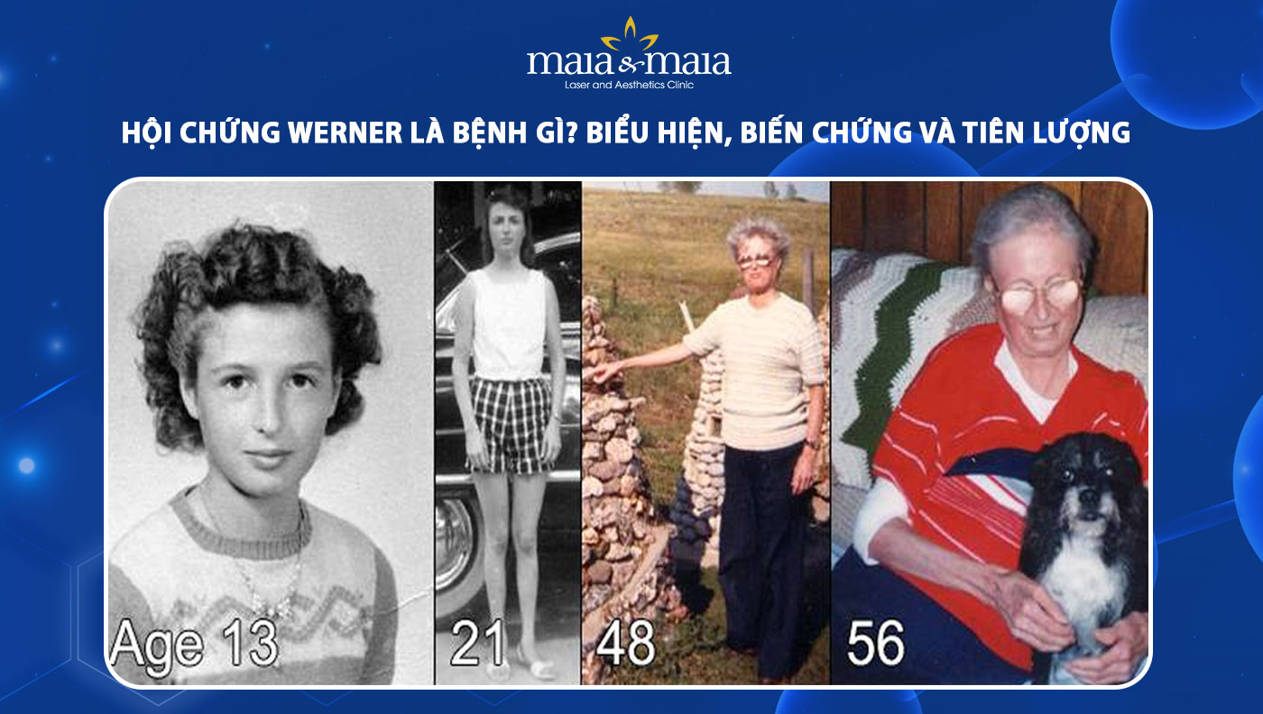 hội chứng werner