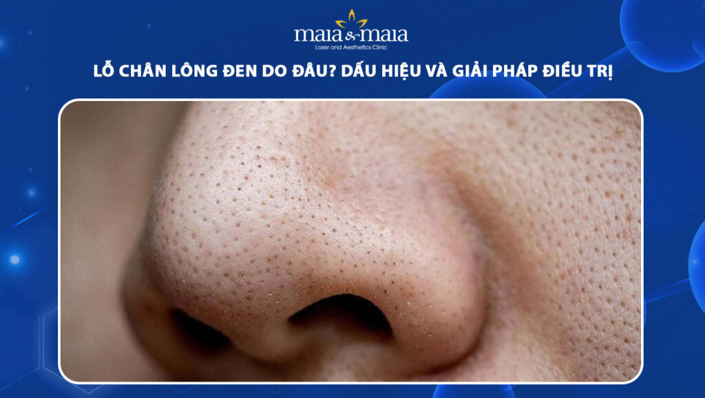lỗ chân lông đen