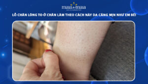 lỗ chân lông to ở chân