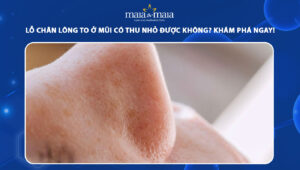 lỗ chân lông to ở mũi