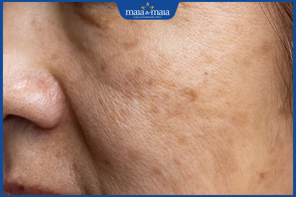 Lão hóa ngoại sinh là thế nào? Nguyên nhân & cách phòng ngừa 2 nám do ánh nắng