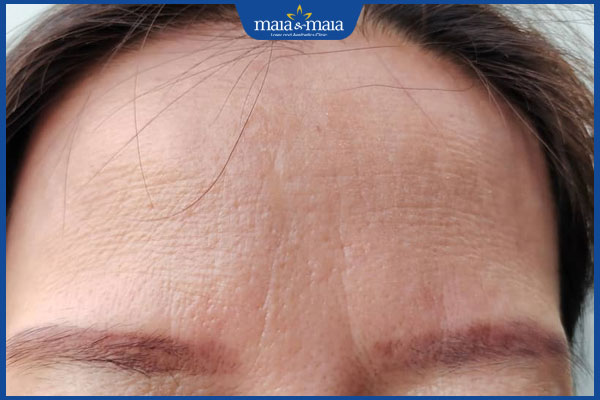 Muốn tiêm căng bóng da mặt an toàn đọc kinh nghiệm dưới đây 3 nếp nhăn trán