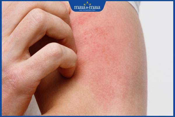 Phác đồ điều trị viêm da dị ứng theo từng mức độ bệnh 2 ngứa ngáy