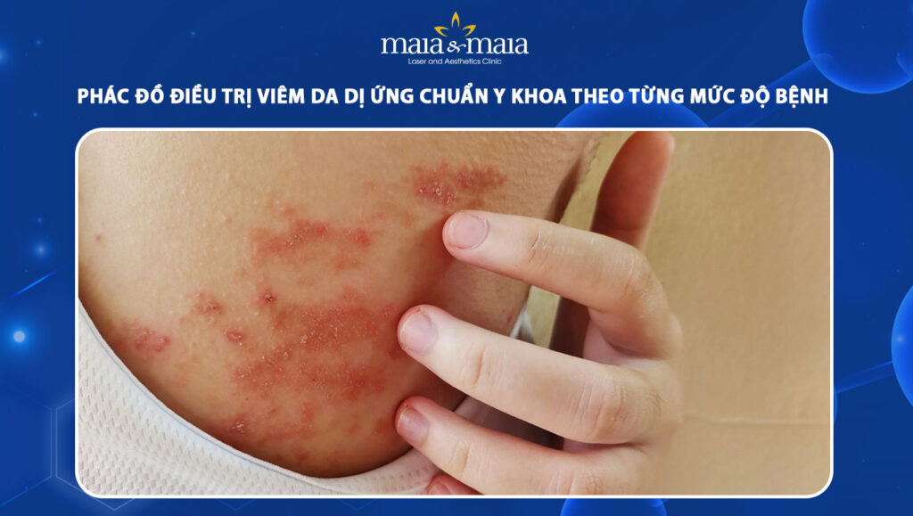 Phác đồ điều trị viêm da dị ứng theo từng mức độ bệnh 1 phác đồ điều trị viêm da dị ứng