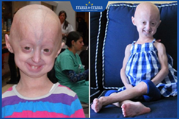 Hội chứng Progeria là gì? Nguyên nhân và cách điều trị 2 Progeria