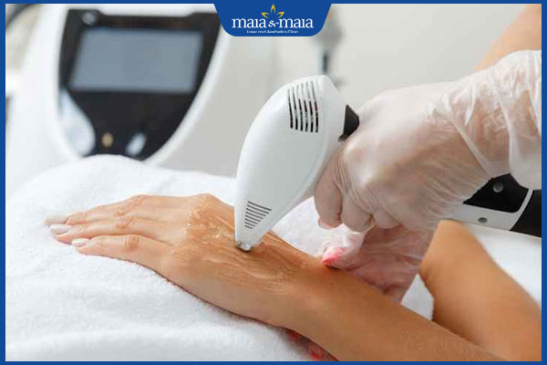 Trẻ hóa bàn tay là gì? Phương pháp hiệu quả và chi phí thực hiện 4 thermage trẻ hóa tay