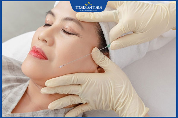 thực hiện căng chỉ rãnh cười