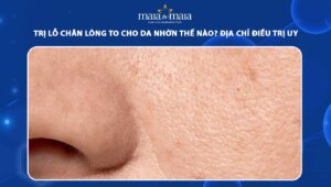 trị lỗ chân lông to cho da nhờn